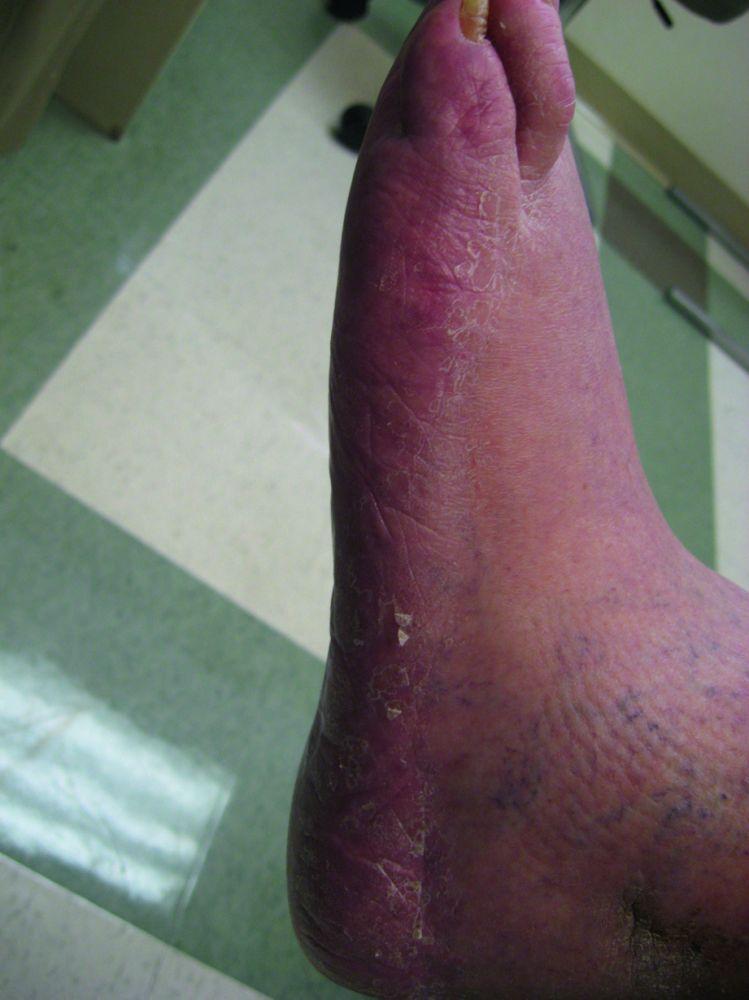 Tinea pedis com descamação e eritema da região lateral do pé