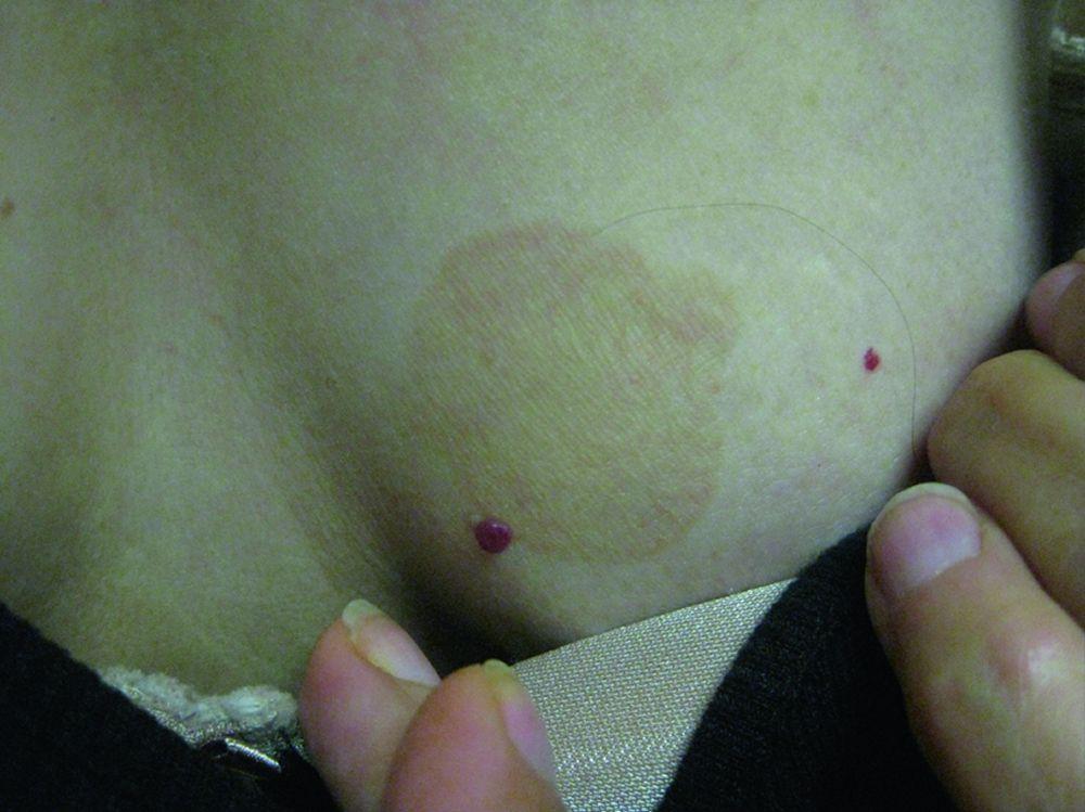 Tinea Versicolor With a Brown Patch