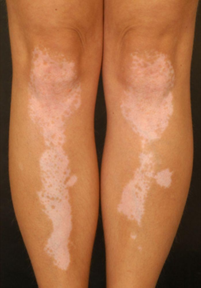 Symmetrische Vitiligo an den Beinen