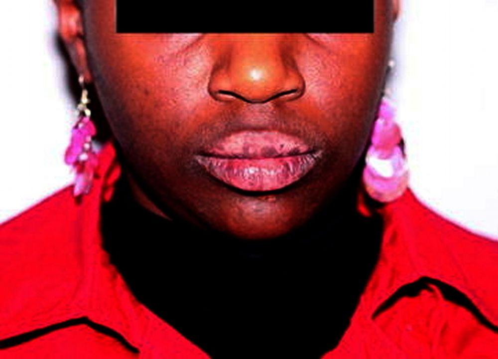 Vitiligo mit Befall der Lippen betrifft
