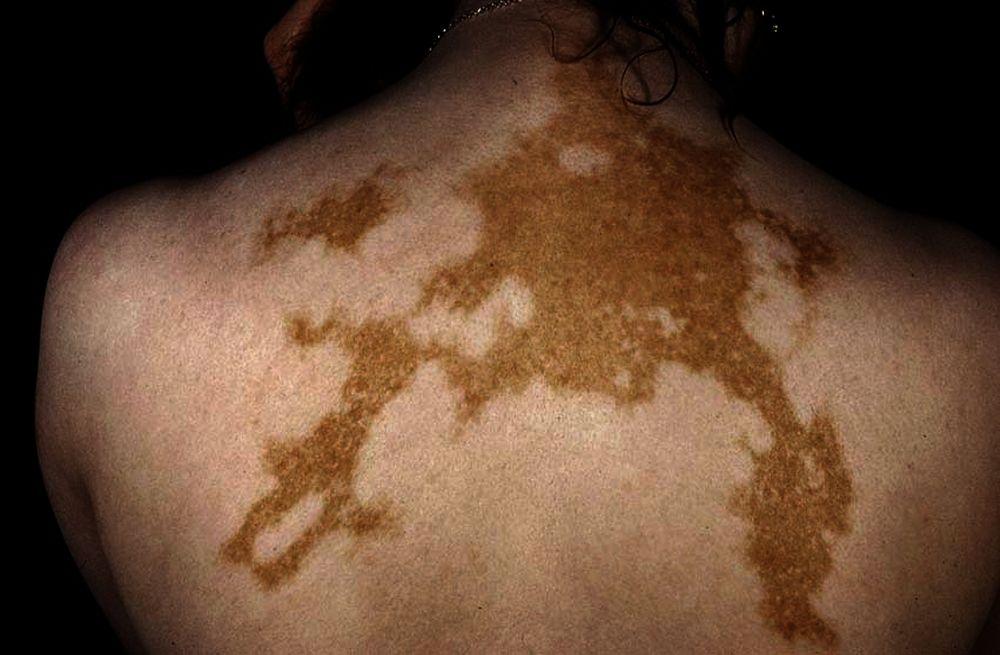 Universelle Vitiligo auf dem Rücken