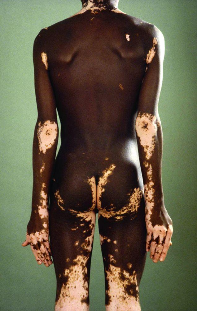 Vitiligo que contrasta con la piel oscura