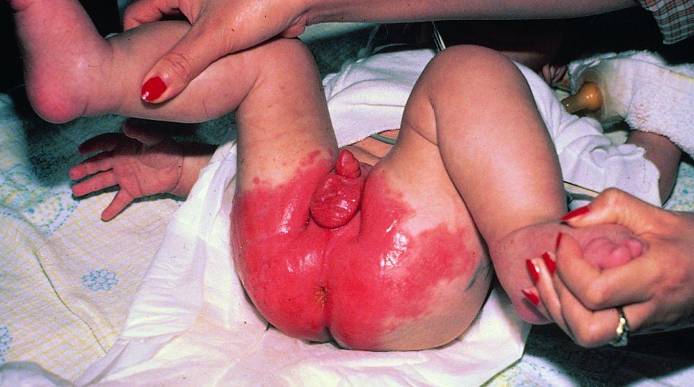 Acrodermatite entéropathique avec dermatite périanale et périnéale sévère