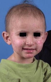 小児の腸性肢端皮膚炎