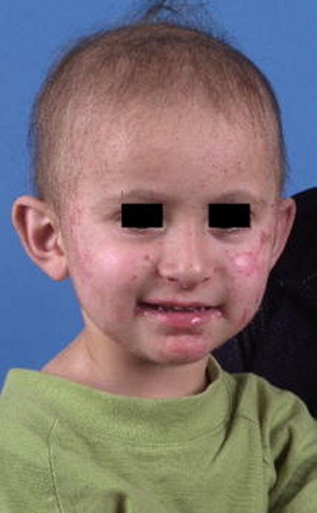 Viêm da đầu chi - ruột ở một trẻ