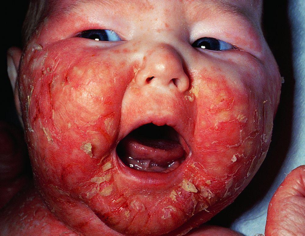 Acrodermatite enteropatica con grave dermatite facciale