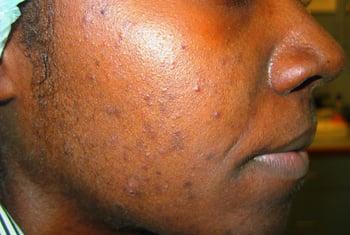 Acne inflamatória com hiperpigmentação