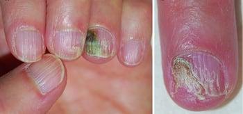Sindrome delle unghie verdi