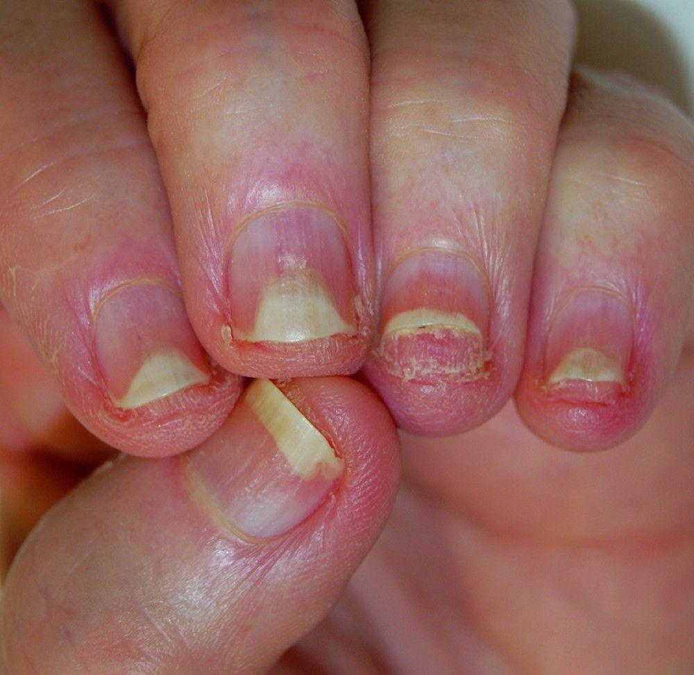 Nail Bed Psoriasis With Onycholysis