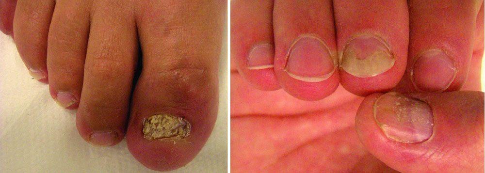 Nail Psoriasis With Thickening and Crumbling of the Nail Plate