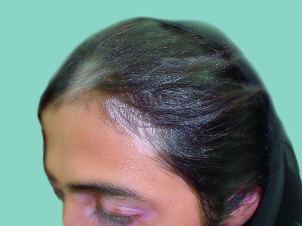 Vitiligo mit Depigmentierung der Haare