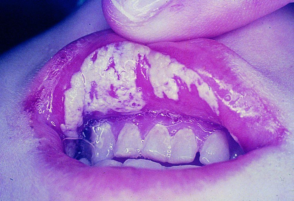 Candidiasis oral (mucosa labial)