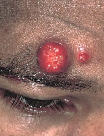 Angiomatosis bacilar (en un paciente con infección por HIV)