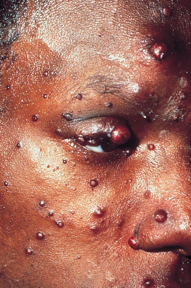 Bartonelose disseminada na infecção pelo HIV