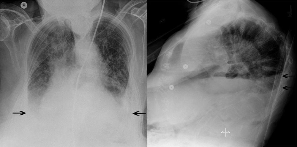 Radiografía de tórax de un paciente con derrames pleurales bilaterales