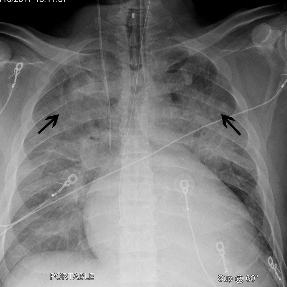 Radiographie pulmonaire d'un patient présentant une cardiomégalie et une céphalisation