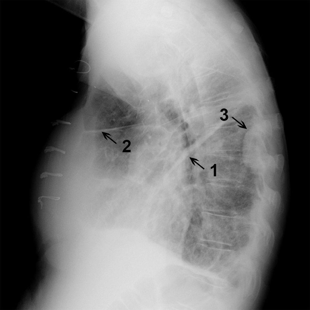 Radiografia do tórax de um paciente com líquido em pequenas e grandes fissuras