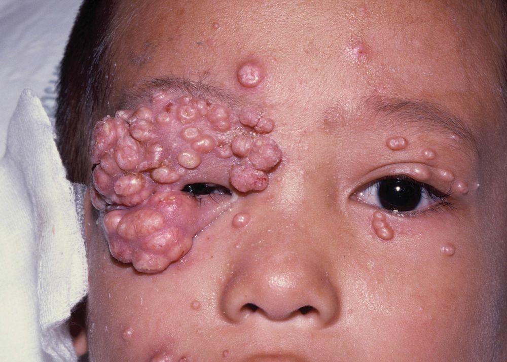 Molluscum contagiosum bei einem Kind mit HIV-Infektion