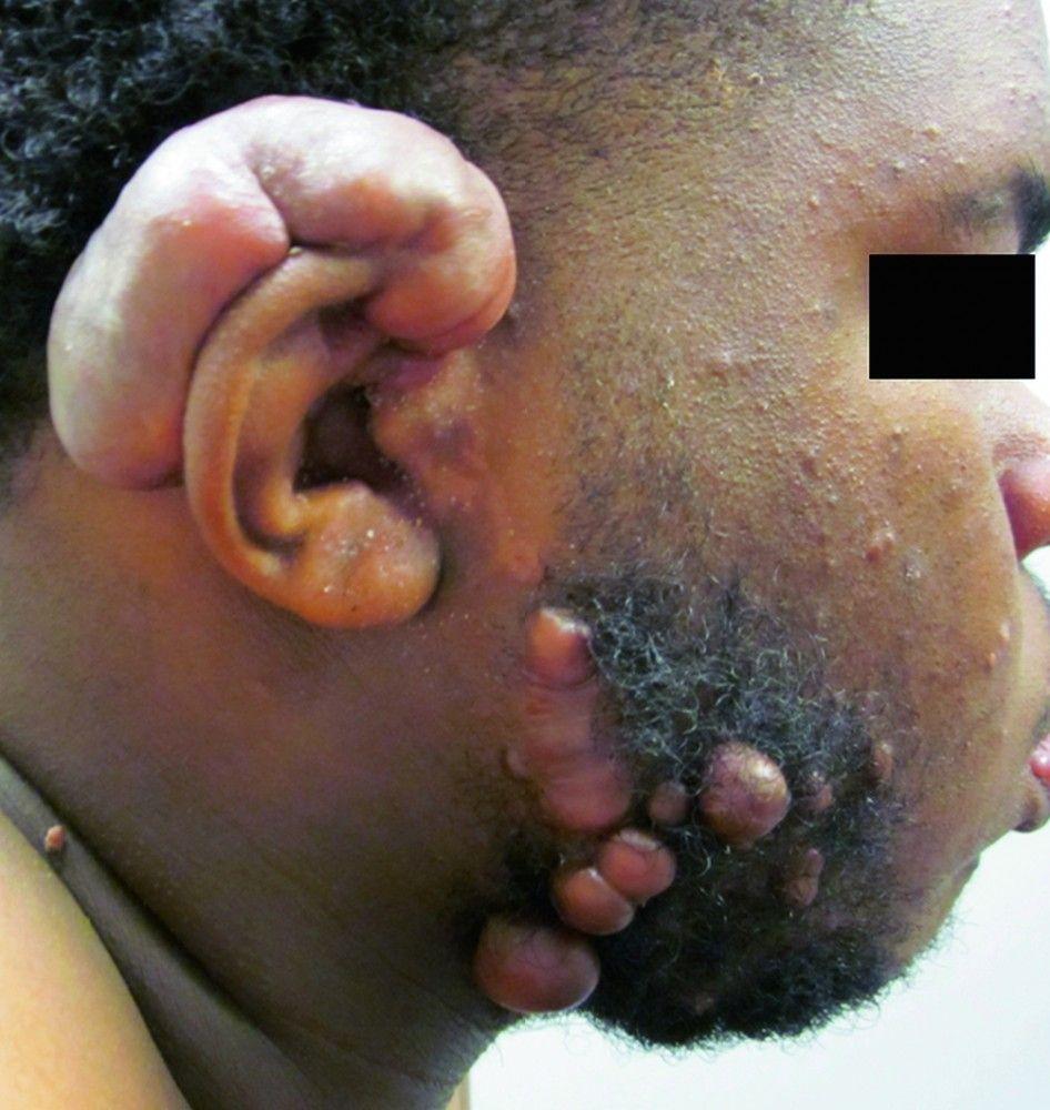 Keloids on the Ear and Face