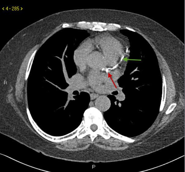 冠動脈石灰化の単純CT