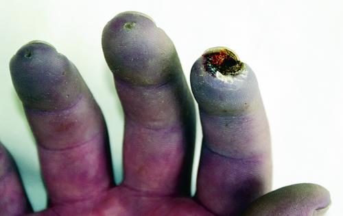 手指の壊疽を伴うレイノー症候群