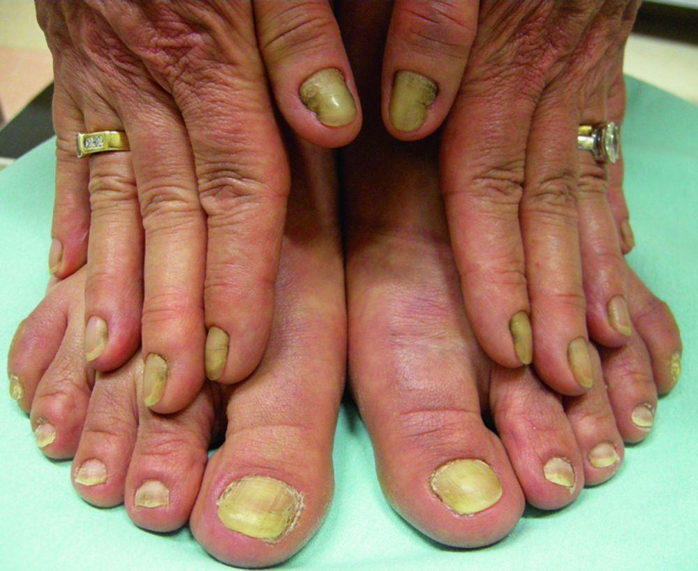 Sindrome delle unghie gialle