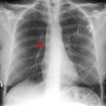 Radiografía de un catéter venoso central