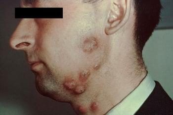 Дерматомикоз бороды и усов (кольцевидные эритематозные поражения)