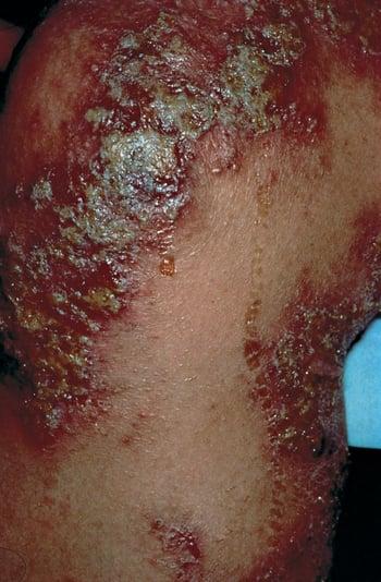 Dermatitis atópica aguda con infección secundaria