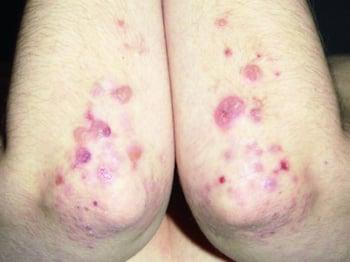Dermatite herpetiforme nos cotovelos