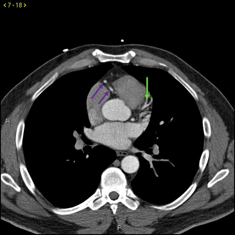 TC com contraste mostrando artérias coronárias normais – Diapositivo 3
