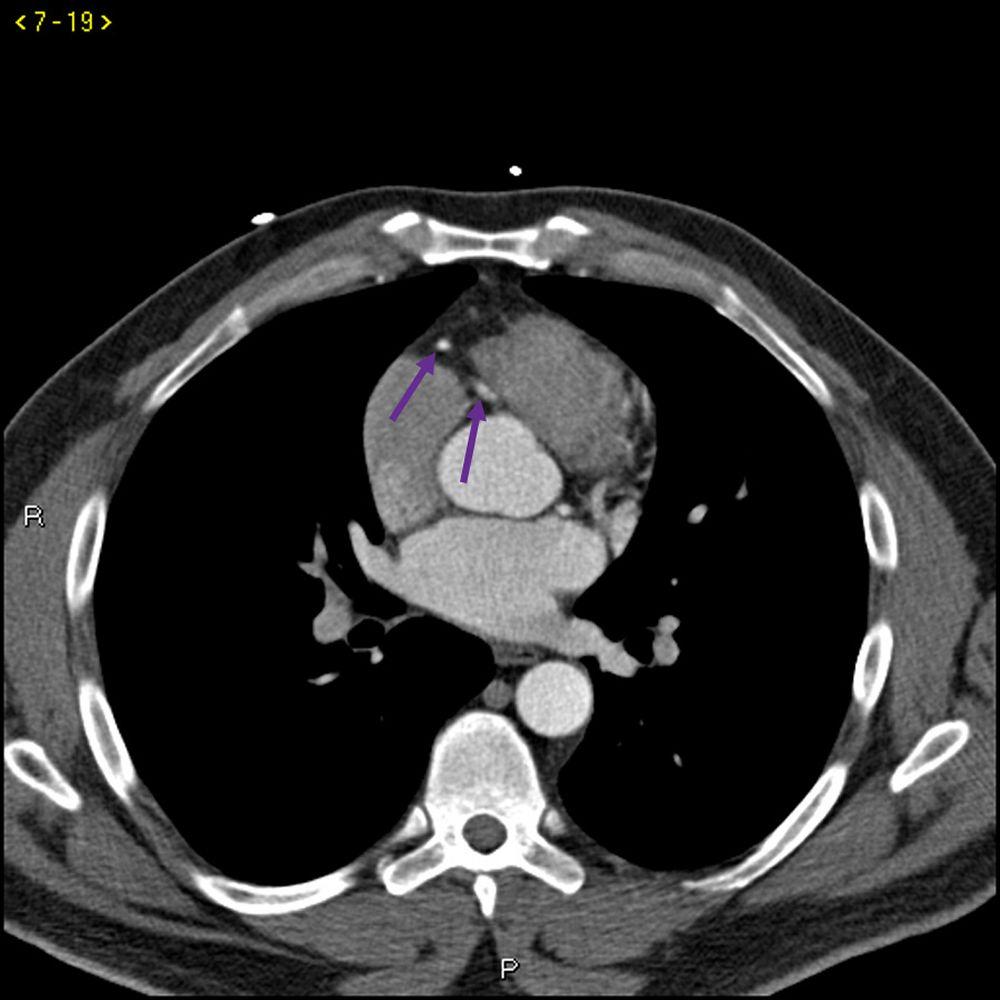Phim chụp CT có thuốc cản quang cho thấy các động mạch vành bình thường – Lát cắt 4