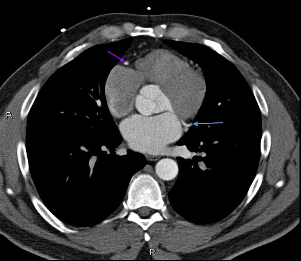TC com contraste mostrando artérias coronárias normais – Diapositivo 6