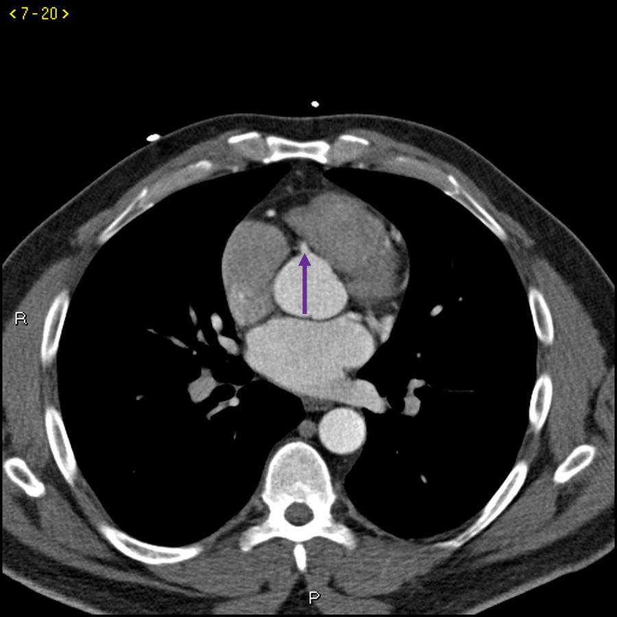 Kontrast CT zeigt normale Koronararterien - Folie 5