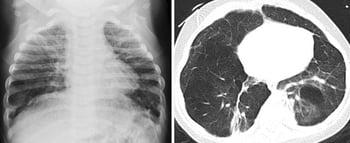 Loạn sản phế quản phổi (Kết quả chụp X-quang và CT)