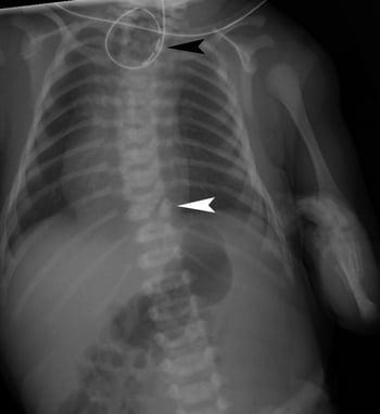 VACTERL (anomalie vertebrali, atresia anale, malformazioni cardiache, fistola tracheoesofagea, atresia esofagea, anomalie renali e aplasia radiale, e altre anomalie degli arti) (anomalie ai raggi X)