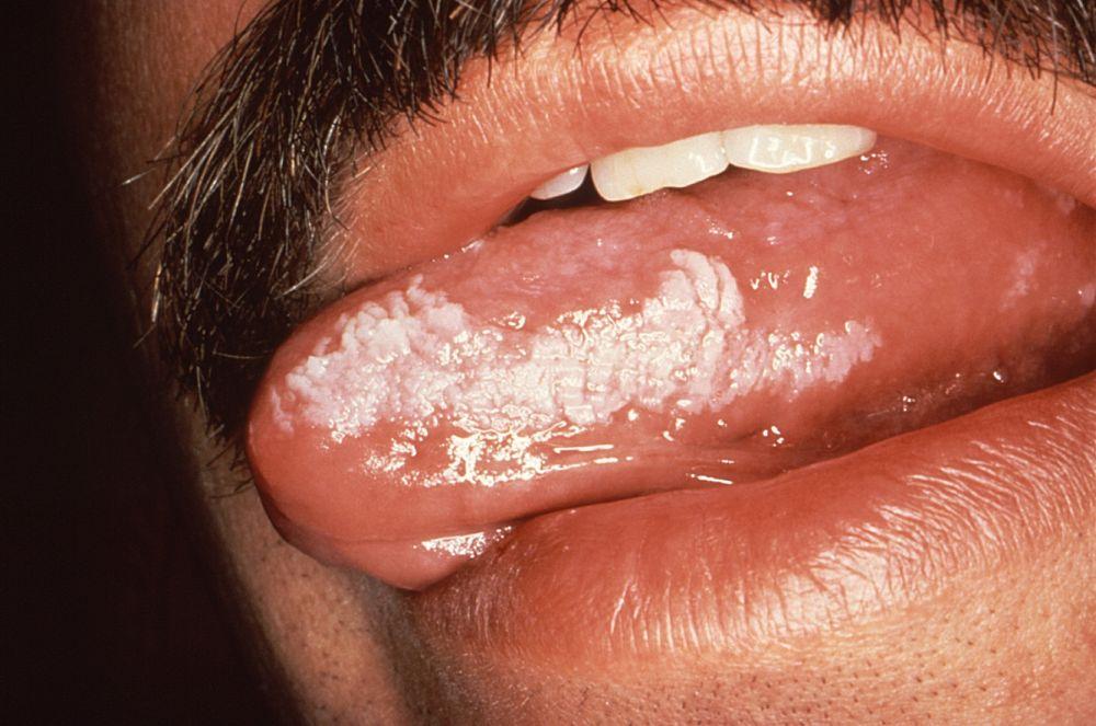 Leucoplasie orale chevelue
