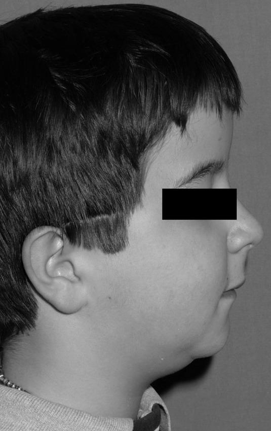 濃化異骨症（下顎の後退）