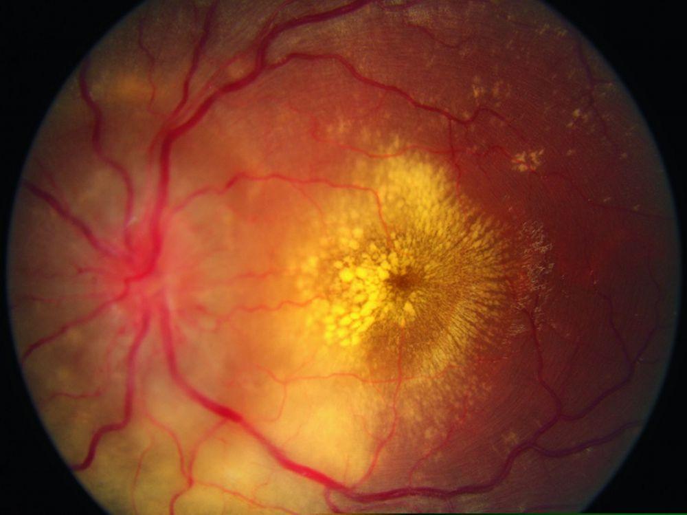 Гипертоническая ретинопатия (экссудаты в форме звезды и отек диска зрительного нерва)