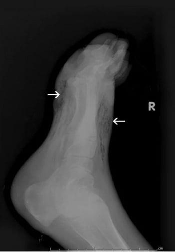 Hoại thư ở bàn chân (X-quang)
