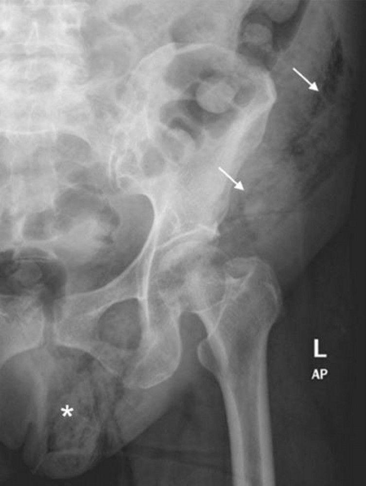 Fournier Gangrene (Abdominal X-Ray)