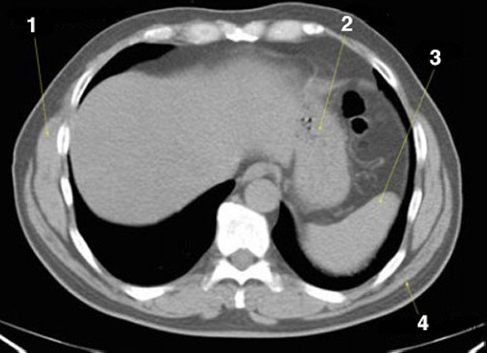 CT-Scan von Abdomen und Becken mit normaler Anatomie ohne Kontrastmittel (Folie 2)