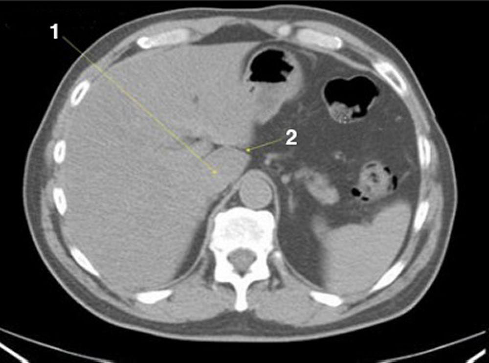 CT-Scan von Abdomen und Becken mit normaler Anatomie ohne Kontrastmittel (Folie 4)
