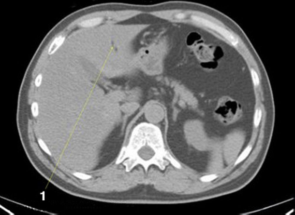 Noncontrast CT Scan of the Abdomen and Pelvis Showing Normal Anatomy (Slide 5)