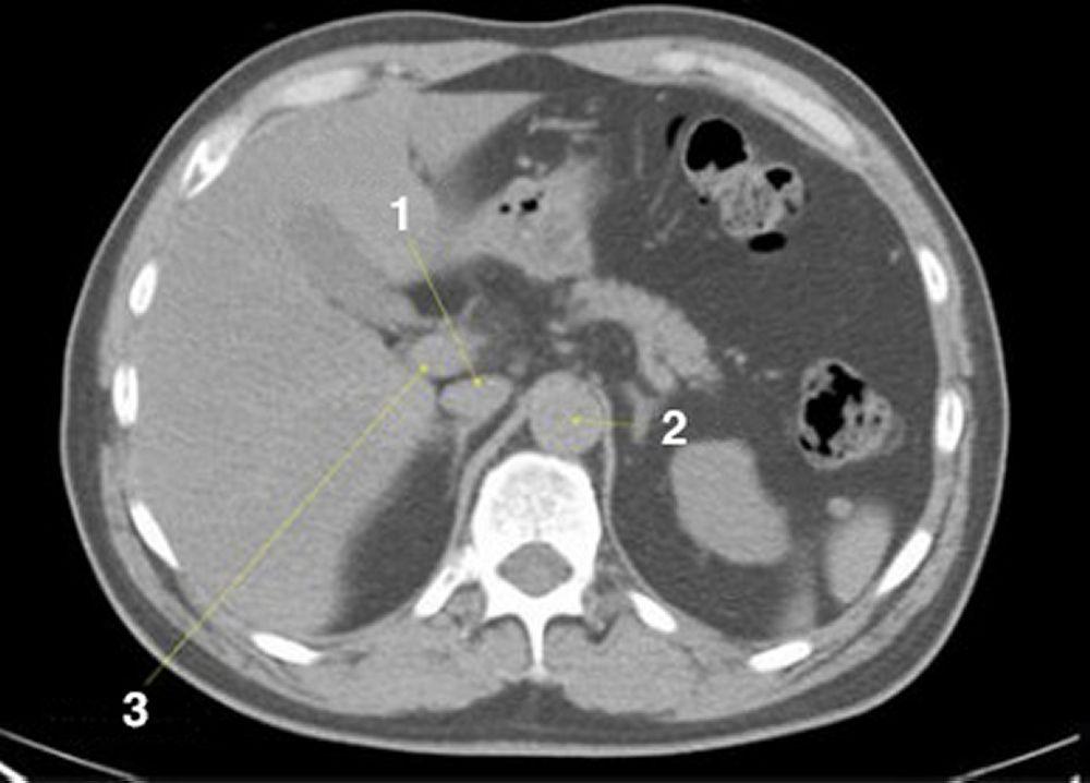 CT-Scan von Abdomen und Becken mit normaler Anatomie ohne Kontrastmittel (Folie 6)