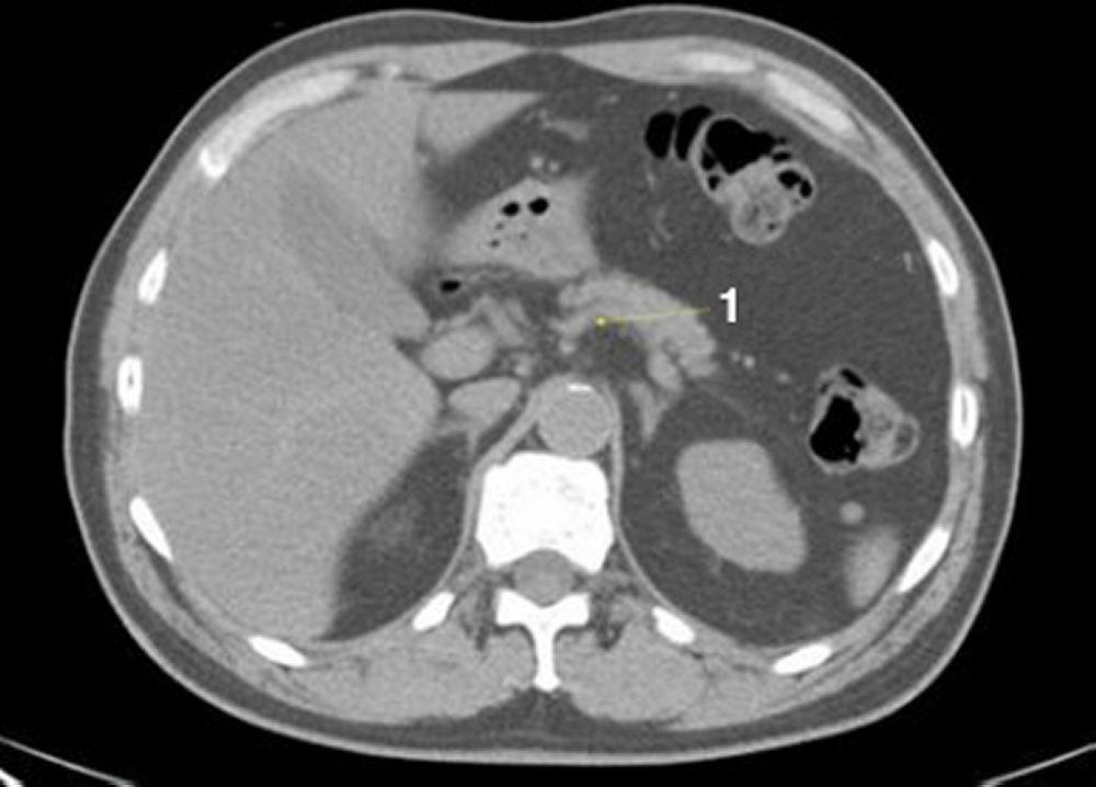 CT-Scan von Abdomen und Becken mit normaler Anatomie ohne Kontrastmittel (Folie 7)