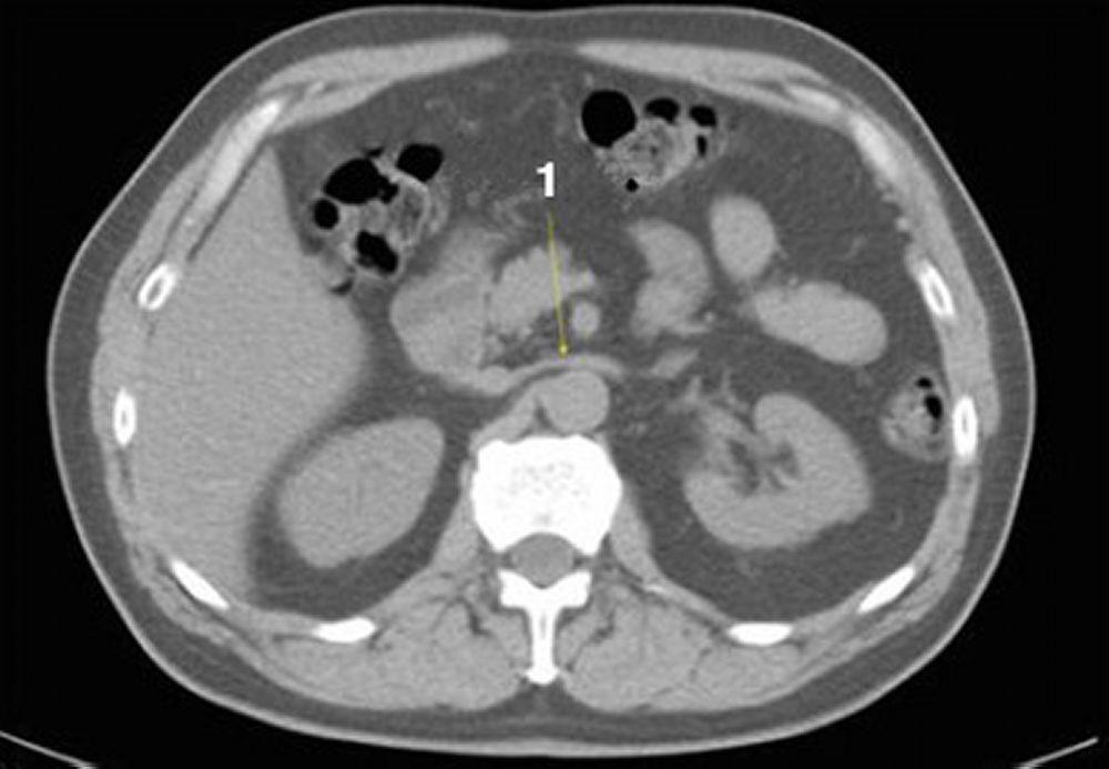 CT-Scan von Abdomen und Becken mit normaler Anatomie ohne Kontrastmittel (Folie 12)
