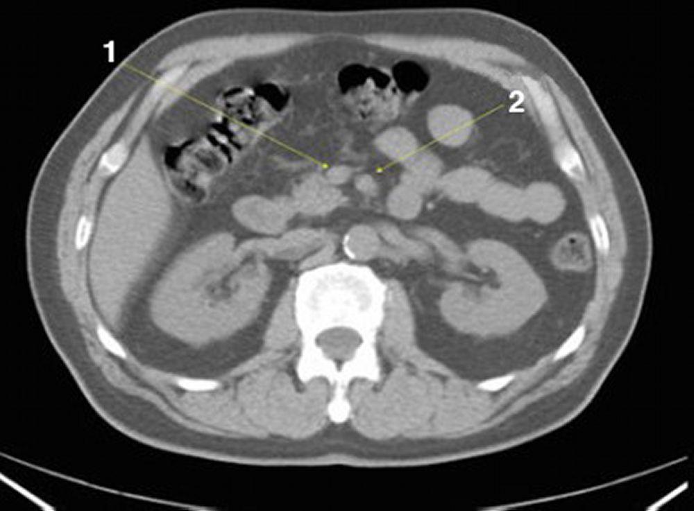 CT-Scan von Abdomen und Becken mit normaler Anatomie ohne Kontrastmittel (Folie 13)