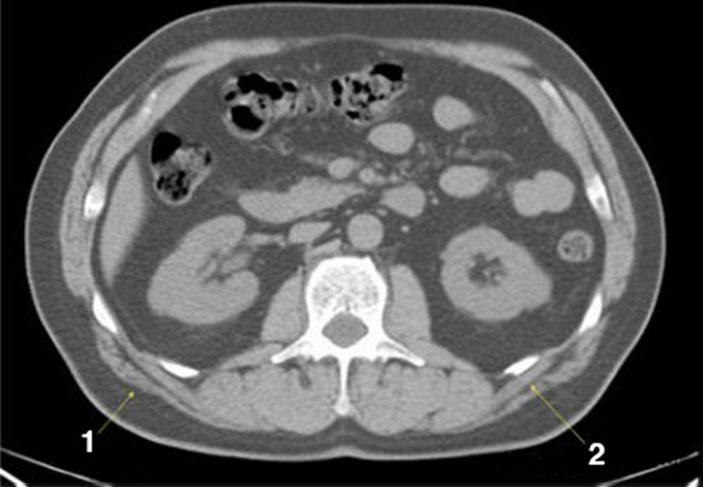CT-Scan von Abdomen und Becken mit normaler Anatomie ohne Kontrastmittel (Folie 15)