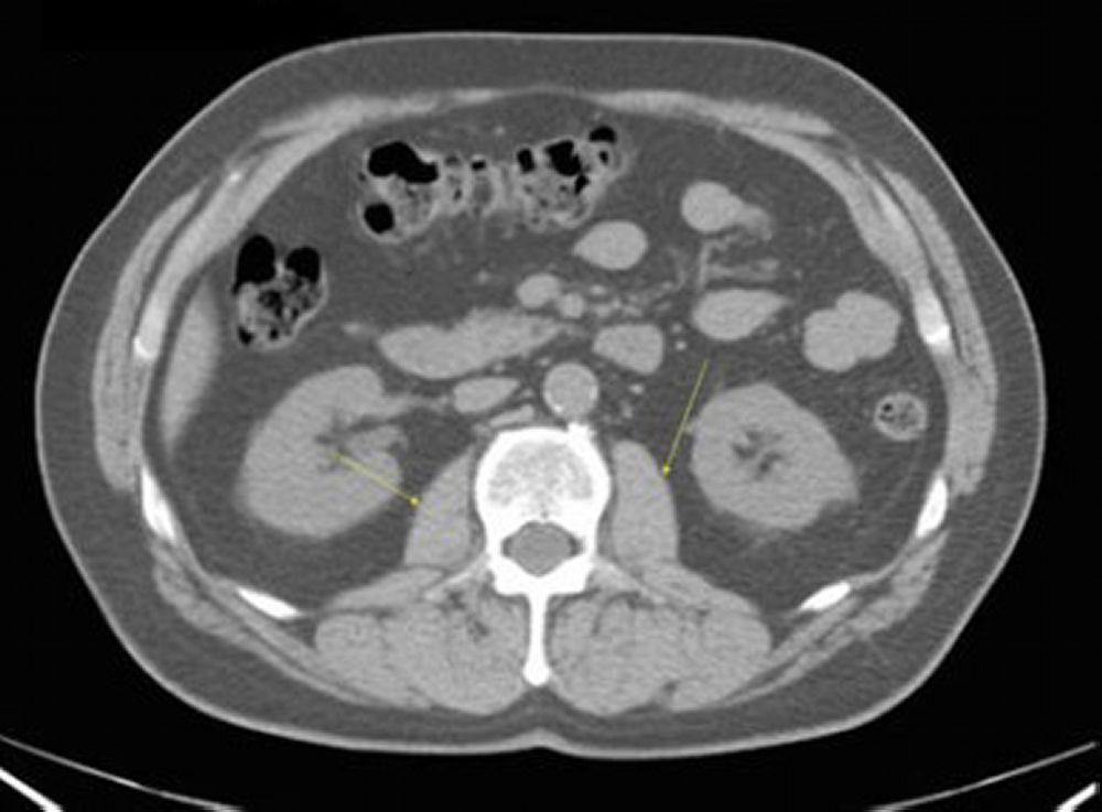 CT-Scan von Abdomen und Becken mit normaler Anatomie ohne Kontrastmittel (Folie 18)